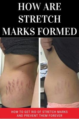 Can You Get Stretch Marks from Scratching? Exploring the Myths and Realities